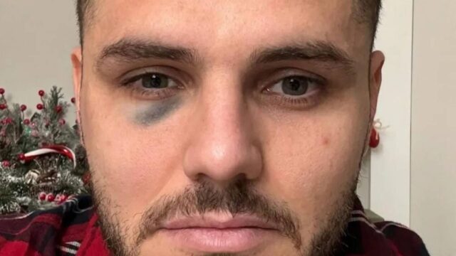 Icardi occhio nero
